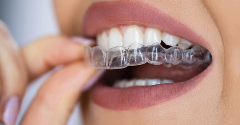 invisalign em atibaia